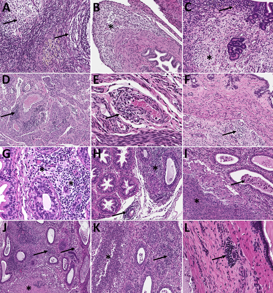 Histopathologic findings in reproductive tissues of strain 13/N guinea pigs with lethal disease after Lassa virus (LASV) strain Josiah infection in study of guinea pig model for LASV infection of reproductive tract and considerations for sexual and vertical transmission. Panels A–F depict samples from female guinea pigs; panels G–L depict samples from male guinea pigs. A) Ovary (25 days postinfection [dpi]) with moderate perivascular and interstitial inflammation (arrows). B) Oviduct (20 dpi) with focal interstitial inflammation and edema (asterisk) within the serosa. C) Uterus (23 dpi) with mild endometrial inflammation and edema (asterisk) and hemosiderin-laden macrophages (arrow). D) Uterus (25 dpi) with multifocal mononuclear inflammatory cells (arrow) forming partial cuffs around vessels in the myometrium. E) Uterine vessel (23 dpi) with mural infiltration by lymphocytes and plasma cells (arrow). F) Cervix (23 dpi) with multifocal, mild, perivascular inflammation (arrow). G) Epididymis (26 dpi) with moderate perivascular inflammation (asterisks). H) Epididymis (23 dpi) with multifocal interstitial inflammation around tubules (asterisk) and a vessel (arrow). I) Epididymis (26 dpi) with marked epididymitis with tubular dilation by inflammatory cells (arrow) and rupture, associated with sperm granuloma formation (asterisk). J) Epididymis (23 dpi) with marked epididymitis, with interstitial inflammation (arrows), and intratubular heterophils associated with rupture and granuloma formation (asterisk). K) Epididymis (26 dpi) with marked interstitial inflammation (arrow) and tubular epithelial necrosis with heterophils (asterisk). L) Prostate (23 dpi) with mild focal lymphocytic, perivascular inflammation (arrow). Hemotoxylin and eosin stain. Original magnifications ×20 (panels A, E, G, I, K), ×15 (panels B, H), and ×10 (panels C, D, F, J, L).
