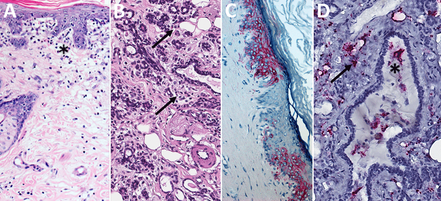Histopathologic findings and detection of Lassa virus (LASV) antigens and RNA in mammary tissues by immunohistochemistry (IHC) and in situ hybridization (ISH) in strain 13/N guinea pigs lethally infected with LASV strain Josiah in study of guinea pig model for LASV infection of reproductive tract and considerations for sexual and vertical transmission. A) Mammary skin (23 dpi), hematoxylin and eosin stain. Mild interstitial lymphoplasmacytic infiltrates and edema (asterisk) in the superficial dermis. B) Mammary gland (25 dpi), hematoxylin and eosin stain. Mild interstitial lymphoplasmacytic infiltrates (arrows) in the periglandular stroma. C) Mammary skin (23 dpi), IHC. Staining in keratinocytes of the epidermis. D) Mammary gland (23 dpi), ISH. Staining around vessels and within the stroma between glands (arrow) and within cells in a mammary duct lumen (asterisk). Original magnifications ×10 (panels A–C), ×20 (panel D).