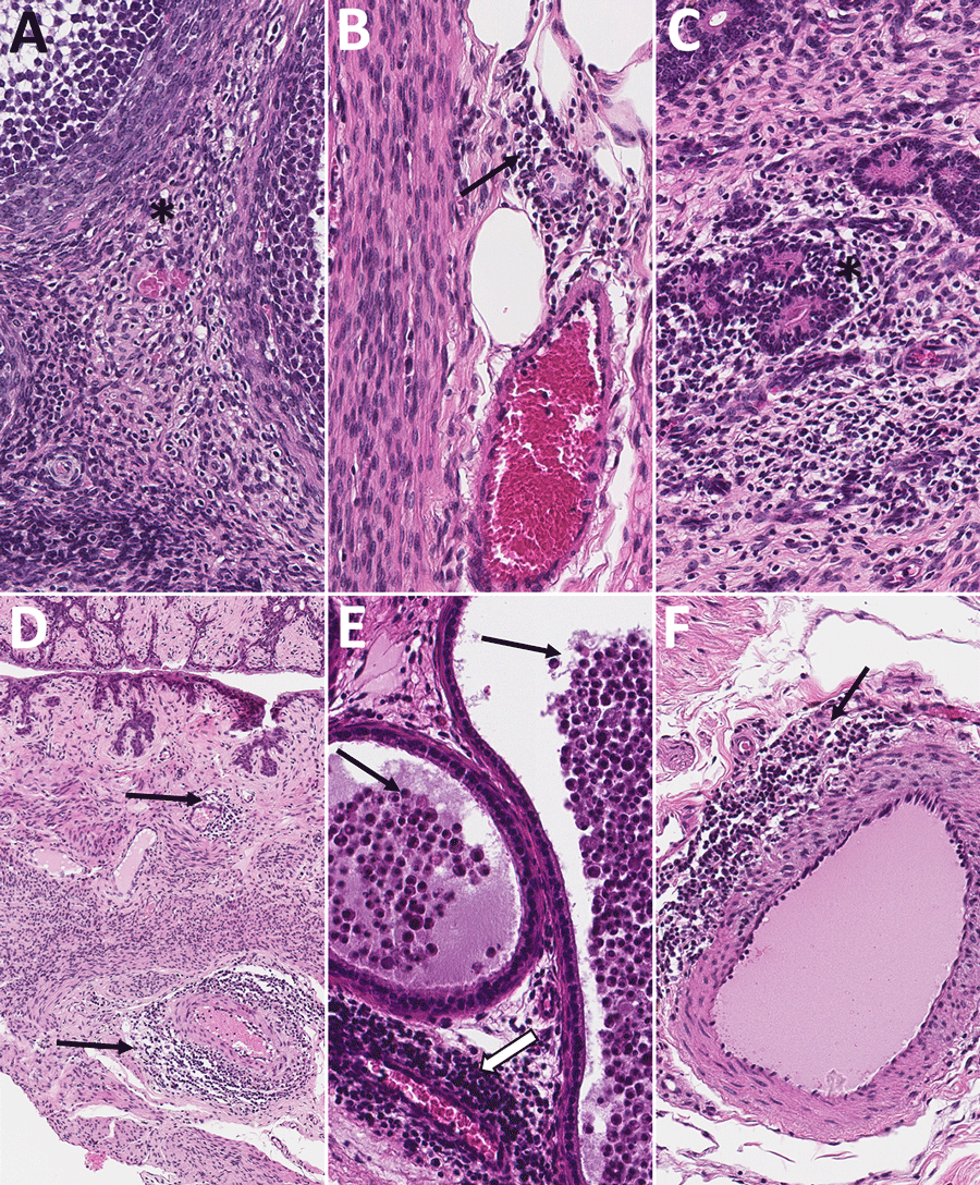 Histopathologic findings in reproductive tissues from strain 13/N guinea pig survivors of Lassa virus strain Josiah infection at 42 days postinfection (dpi) in study of guinea pig model for Lassa virus infection of reproductive tract and considerations for sexual and vertical transmission. Panels A–D depict samples from female guinea pigs; panels E–F depict male samples from male guinea pigs. A) Ovary (42 dpi) with lymphoplasmacytic inflammation in the stroma (asterisk). B) Oviduct (42 dpi) with focal perivascular and interstitial inflammation (arrow). C) Uterus (42 dpi) with endometrial stromal lymphoplasmacytic inflammation (asterisk) around glands. D) Vagina (42 dpi) with lymphocytic inflammation (arrows) around vessels in the vaginal wall. E) Epididymis (42 dpi) with dense perivascular lymphoplasmacytic inflammation around a vessel (white arrow) and heterophils within tubular lumens (black arrows). F) Penile connective tissue (42 dpi) with perivascular lymphocytic inflammation (arrow). Hematoxylin and eosin stain. Original magnification ×40 (panels A–C, E, F), ×10 (panel D).