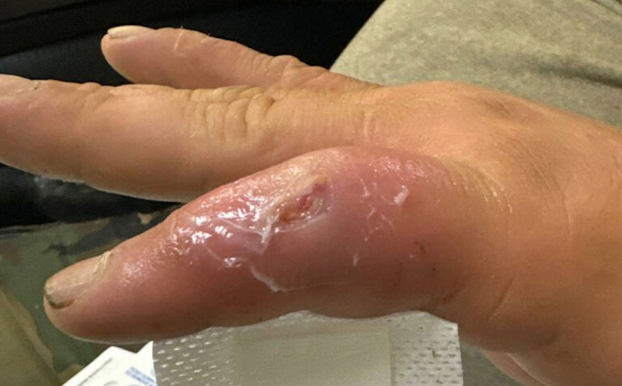 Finger laceration in case of septic arthritis and osteomyelitis in finger caused by Mycoplasma phocimorsus from brown bear (Ursus arctos), Alaska, 2024. Left fifth finger laceration occurred while skinning a brown bear. Laceration is shown overlying the proximal interphalyngeal joint with surrounding edema.