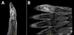 Magnetic resonance imaging in case of septic arthritis and osteomyelitis in finger caused by Mycoplasma phocimorsus from brown bear (Ursus arctos), Alaska, 2024. Left fifth finger sagittal (A) and coronal (B) images demonstrate edema of the proximal and middle phalanges on short tau inversion recovery sequences, suggestive of osteomyelitis.