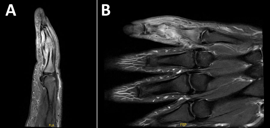 Magnetic resonance imaging in case of septic arthritis and osteomyelitis in finger caused by Mycoplasma phocimorsus from brown bear (Ursus arctos), Alaska, 2024. Left fifth finger sagittal (A) and coronal (B) images demonstrate edema of the proximal and middle phalanges on short tau inversion recovery sequences, suggestive of osteomyelitis.