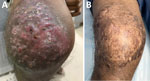 Anterior right knee of patient treated with linezolid and meropenem for Nocardia otitidiscaviarum actinomycetoma, India. A) Multiple nodules with overlying sinuses over right knee. B) Near-complete resolution with subsidence of sinuses and nodules leaving behind scarring after 2 months of treatment with a 21-day cycle of linezolid and meropenem combined with trimethoprim/sulfamethoxazole.