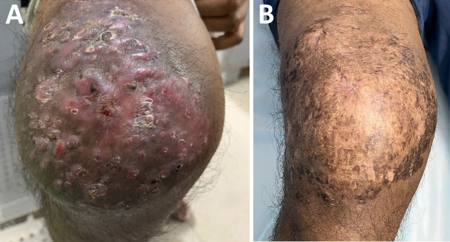 Anterior right knee of patient treated with linezolid and meropenem for Nocardia otitidiscaviarum actinomycetoma, India. A) Multiple nodules with overlying sinuses over right knee. B) Near-complete resolution with subsidence of sinuses and nodules leaving behind scarring after 2 months of treatment with a 21-day cycle of linezolid and meropenem combined with trimethoprim/sulfamethoxazole.