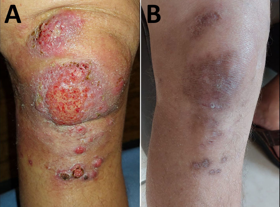 Cutaneous infection on the right knee before and after treatment from study of Mycobacterium decipiens infection in a patient treated with anti–tumor necrosis factor-α therapy, France, 2024. A) Before treatment: erythematous, exudative, budding lesion over the patella with multiple satellite nodules. B) After treatment: residual pigmented macular lesions, sometimes depressed, consistent with postinflammatory changes.