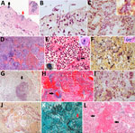 Pulmonary microscopic findings in patients with fatal yellow fever, São Paulo, Brazil, 2017–2019. A) Tracheal necrosis associated with bacilli (black arrow) and yeasts (inset and red arrow). Hematoxylin and eosin (HE) stain; scale bar = 50 µm. B) Candida albicans pseudohyphae and hyphae invading necrotic tracheal mucosa. Gram stain in immersion oil; scale bar = 10 µm. C) Bronchopneumonia associated with gram-negative bacilli. Gram stain; scale bar = 20 µm. D) Hemorrhagic pneumonia with microabscess composed of macrophages, neutrophils and colonies of coccus. HE stain; scale bar = 100 µm. E) Suppurative pneumonia showing hemophagocytosis (right inset) and a megakaryocyte in a septal vessel (arrow), with emperipolesis. HE stain; scale bar = 20 µm. Left inset: megakaryocyte labeled by VIII factor antigen detected by immunohistochemistry. Peroxidase stain. F) Polymicrobial aspirative pneumonia with gram-positive cocci and gram-positive and gram-negative bacilli with different morphologies; the inset shows a colony of bacilli in a septal vessel corresponding to agonal bacteremia. Gram stain; scale bar = 20 µm. Inset: HE stain. G) Actynomyces granule (arrow) with degenerated squamous cells in the center in an area of aspirative pneumonia. HE stain; scale bar = 100 µm. H) Pseudomonas hemorrhagic pneumonia, with numerous bacilli surrounding a septal vessel (arrow). HE stain; scale bar = 50 µm. I) Mycoplasma salivarium pneumonia, showing tiny gram-negative bacilli (inset) in the cytoplasm of intrabronchial macrophages. Gram stain; scale bar = 20 µm. J) Bronchoaspiration of vegetal alimentary material, associated with gram-negative bacilli, in the alveolar space. Gram stain; scale bar = 20 µm. K) Pulmonary angioinvasive aspergillosis, with typical hyphae invading pulmonary vessel (arrow), with associated necrosis and mild neutrophilic reaction. Grocott-Gomori methenamine silver stain; scale bar = 20 µm. L) Exudative diffuse alveolar damage, with congestion, alveolar edema, and hyaline membranes (arrow). HE stain; scale bar = 100 µm. Insets: original magnification ×400.