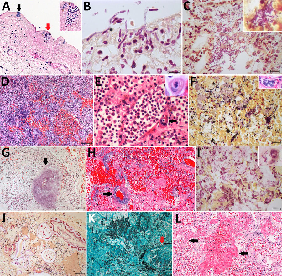 Pulmonary microscopic findings in patients with fatal yellow fever, São Paulo, Brazil, 2017–2019. A) Tracheal necrosis associated with bacilli (black arrow) and yeasts (inset and red arrow). Hematoxylin and eosin (HE) stain; scale bar = 50 µm. B) Candida albicans pseudohyphae and hyphae invading necrotic tracheal mucosa. Gram stain in immersion oil; scale bar = 10 µm. C) Bronchopneumonia associated with gram-negative bacilli. Gram stain; scale bar = 20 µm. D) Hemorrhagic pneumonia with microabscess composed of macrophages, neutrophils and colonies of coccus. HE stain; scale bar = 100 µm. E) Suppurative pneumonia showing hemophagocytosis (left inset) and a megakaryocyte in a septal vessel (arrow), with emperipolesis. HE stain; scale bar = 20 µm. Inset: megakaryocyte labeled by VIII factor antigen detected by immunohistochemistry. Peroxidase stain. F) Polymicrobial aspirative pneumonia with gram-positive cocci and gram-positive and gram-negative bacilli with different morphologies; the inset show a colony of bacilli in a septal vessel corresponding to agonal bacteremia. Gram stain; scale bar = 20 µm. Inset: HE stain. G) Actynomyces granule (arrow) with degenerated squamous cells in the center in an area of aspirative pneumonia. HE stain; scale bar = 100 µm. H) Pseudomonas hemorrhagic pneumonia, with numerous bacilli surrounding a septal vessel (arrow). HE stain; scale bar = 50 µm. I) Mycoplasma salivarium pneumonia, showing tiny gram-negative bacilli (inset) in the cytoplasm of intrabronchial macrophages. Gram stain; scale bar = 20 µm. J) Bronchoaspiration of vegetal alimentary material, associated with gram-negative bacilli, in the alveolar space. Gram stain; scale bar = 20 µm. K) Pulmonary angioinvasive aspergillosis, with typical hyphae invading pulmonary vessel (arrow), with associated necrosis and mild neutrophilic reaction. Grocott-Gomori methenamine silver stain; scale bar = 20 µm. L) Exudative diffuse alveolar damage, with congestion, alveolar edema, and hyaline membranes (arrow). HE stain; scale bar = 100 µm. Insets: original magnification ×400.