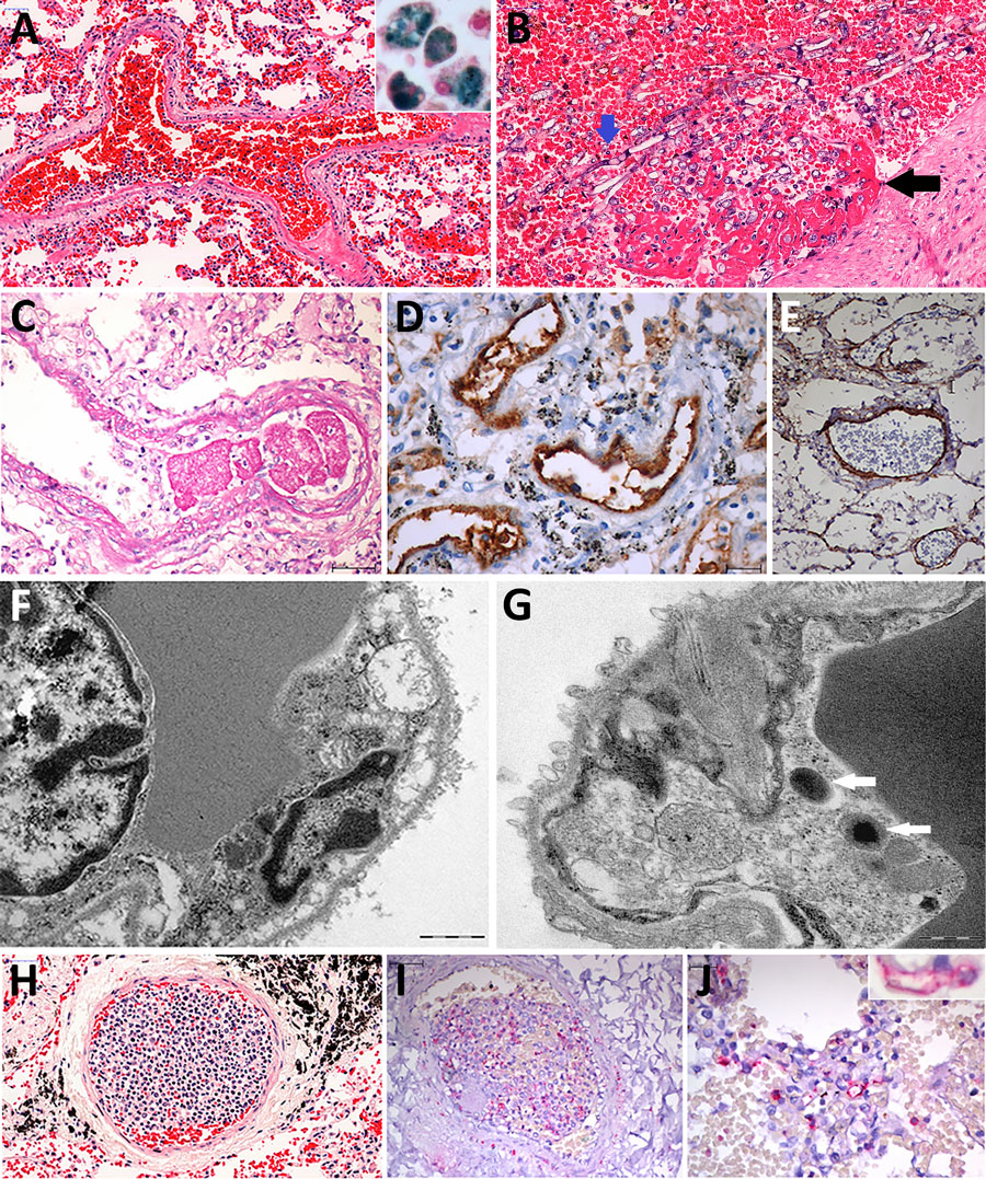 Pulmonary vascular damage in fatal yellow fever cases, 2017–2019 epidemic, São Paulo, Brazil. A) Medium-sized artery with fibrinoid necrosis of the endothelial layer, marginated leukocytes, wall edema, septal congestion, alveolar hemorrhage. Hematoxylin and eosin (HE) stain; scale bar represents 50 µm. Inset shows a group of hemosiderin-laden alveolar macrophages stained for iron. Perls stain; original magnification ×200. B) Pulmonary artery showing angioinvasion by Aspergillus spp. forming fibrinous thrombus on the endothelial vascular layer (black arrow). HE stain; scale bar (top) represents 50 µm. C) A small fibrin clot and the artery fibrinoid necrosis and wall edema. Periodic acid–Schiff stain; scale bar represents 50 µm. D) Positive detection of VIII coagulation factor in the entire wall of pulmonary arteries. Peroxidase stain; scale bar represents 20 µm. E) The VCAM is detected in the endothelial and muscular pulmonary artery layers. Peroxidase stain; scale bar represents 20 µm. F) Septal capillaries showing mitochondrial dilation with loss of cristae. Ultrathin section; scale bar represents 1 µm. G) Bacilli (arrows) within septal pulmonary vessel. Ultrathin section; scale bar represents 500 nm. H) Histologic leukostasis in a septal pulmonary artery, showing immature myeloid cells, lymphocytes, and neutrophils. HE stain; scale bar represents 50 µm. I) Intravascular cells expressing yellow fever virus antigens in their cytoplasm. Alkaline phosphatase stain; scale bar represents 50 µm. J) The yellow fever virus antigen is detected in the cytoplasm of septal endothelial cells (inset) and in interstitial and alveolar inflammatory cells. Alkaline phosphatase stain; scale bar represents 20 µm. Inset original magnification ×400.