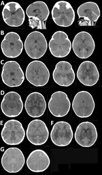 Brain computed tomography imaging for patients with SARS-CoV-2 acute shock with encephalopathy and multiorgan failure/acute fulminant cerebral edema (ASEM/AFCE) for study of life-threatening SARS-CoV-2–associated encephalopathy and multiorgan failure in children, Asia and Oceania, 2022–2024. A) Case-patient 1, showing diffuse cerebral edema (DCE) within 10 hours after onset of neurologic symptoms (left 2 images) and severe DCE and herniation at 18 hours after onset (right 2 images). B) Case-patient 6, showing mild cerebral edema within 4 hours after onset (left 2 images) and severe DCE at 23 hours after onset (right 2 images). C) Case-patient 15, showing DCE 3 hours after onset (left 2 images) and severe DCE with low-density involving the bilateral cerebral white matter and thalamus at 23 hours from the onset (right 2 images). D) Case-patient 19, showing DCE with low-density lesions in the bilateral cerebral white matter within 90 minutes after onset (left 2 images) and severe DCE at 10 hours after onset (right 2 images). E) Case-patient 18, showing mild cerebral edema on day 2 of illness; the patient had no further exacerbation of DCE. F) Case-patent 20, showing DCE with bilateral low-density lesions in the thalamus (left image) and periventricular cerebral white matter within 30 hours after onset (right image). G) Case-patient 23, showing DCE within 7 hours after onset (left image) and a high density of frontal subcortical white matter (right image).