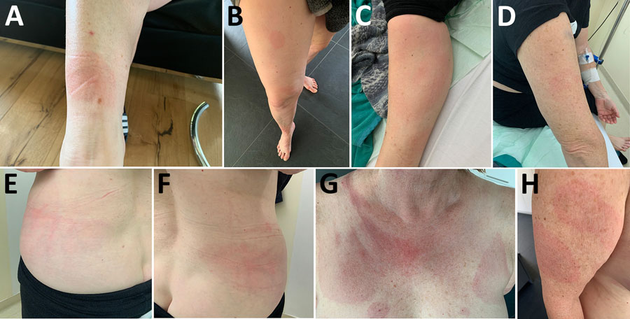 Evolution of cutaneous findings for reported case of early disseminated Lyme borreliosis with multiple erythema migrans and hepatitis in 62-year-old immunosuppressed patient treated with venetoclax and obinutuzumab, Switzerland. A) Oval erythematous rash on the anterior aspect of the right ankle, first lesion to appear (February 20, 2024). B) Right leg with 2 new additional circular/oval patches located on the anterior thigh and anterior knee (March 3, 2024). C–F) Worsening of the exanthemas, with expanding red rash and central clearing (targetoid appearance) on the left leg (C) and onset of red macules on the right arm (D) and the left (E) and right (F) posterolateral trunk (April 9, 2024). G–H) Macules on the décolleté (G) and evolution of cutaneous findings on the right arm, including the appearance of an additional macule (H) (April 27, 2024).