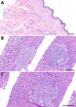 Histopathology of skin and liver for reported case of early disseminated Lyme borreliosis with multiple erythema migrans and hepatitis in a 62-year-old immunosuppressed patient treated with venetoclax and obinutuzumab, Switzerland. A) Skin biopsy from an erythema chronicum migrans lesion on the gluteal region, stained with hematoxylin and eosin. The histology reveals a mild superficial and deep perivascular dermatitis characterized by a sparse, predominantly lymphocytic inflammatory infiltrate, without evidence of plasma cells. B–C) Liver biopsy stained with hematoxylin and eosin showing features of chronic cholestatic hepatitis with superimposed acute cholangitis, while maintaining an overall preserved lobular architecture. Key histological findings include marked sinusoidal dilatation (peliosis); expanded, markedly edematous portal tracts without fibrosis; and prominent ductular proliferates with intraepithelial and intraluminal neutrophilic infiltrates consistent with neutrophilic cholangitis. Neutrophilic infiltrates were also observed within the sinusoids. Additional features included portal ceroid-laden macrophages and microvesicular steatosis. Scale bars indicate 200 µm.
