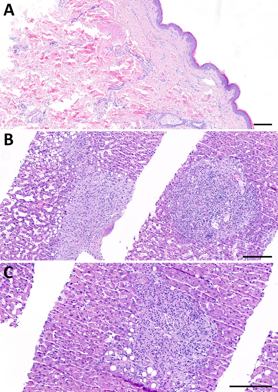 Histopathology of skin and liver for reported case of early disseminated Lyme borreliosis with multiple erythema migrans and hepatitis in a 62-year-old immunosuppressed patient treated with venetoclax and obinutuzumab, Switzerland. A) Skin biopsy from an erythema chronicum migrans lesion on the gluteal region, stained with hematoxylin and eosin. The histology reveals a mild superficial and deep perivascular dermatitis characterized by a sparse, predominantly lymphocytic inflammatory infiltrate, without evidence of plasma cells. B–C) Liver biopsy stained with hematoxylin and eosin showing features of chronic cholestatic hepatitis with superimposed acute cholangitis, while maintaining an overall preserved lobular architecture. Key histological findings include marked sinusoidal dilatation (peliosis); expanded, markedly edematous portal tracts without fibrosis; and prominent ductular proliferates with intraepithelial and intraluminal neutrophilic infiltrates consistent with neutrophilic cholangitis. Neutrophilic infiltrates were also observed within the sinusoids. Additional features included portal ceroid-laden macrophages and microvesicular steatosis. Scale bars indicate 200 µm.