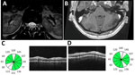 Imaging from study of Guillain-Barré syndrome and visual impairment associated with emerging Oropouche virus lineage, Brazil, 2024. A) T2-weighted magnetic resonance imaging of lumbar spinal cord. Arrows indicate nerve root edema. B) T1-weighted magnetic resonance imaging of brain with contrast. Arrow indicates enhancement of right facial nerve. C, D) Optical coherence tomography of right eye (C) and left eye (D) revealed bilateral loss of ganglionic cells in the papillomacular bundle, shown in white on the circle graphic.