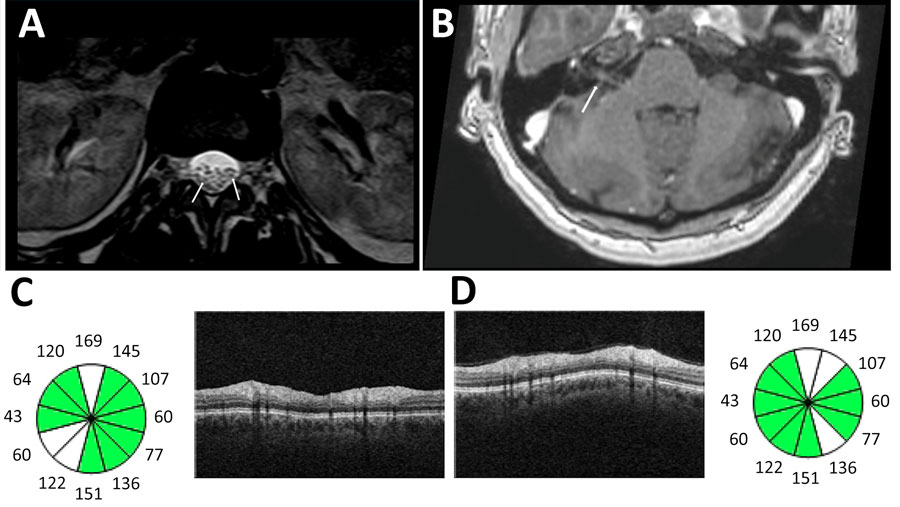 Imaging from study of Guillain-Barré syndrome and visual impairment associated with emerging Oropouche virus lineage, Brazil, 2024. A) T2-weighted magnetic resonance imaging of lumbar spinal cord. Arrows indicate nerve root edema. B) T1-weighted magnetic resonance imaging of brain with contrast. Arrow indicates enhancement of right facial nerve. C, D) Optical coherence tomography of right eye (C) and left eye (D) revealed bilateral loss of ganglionic cells in the papillomacular bundle, shown in white on the circle graphic.