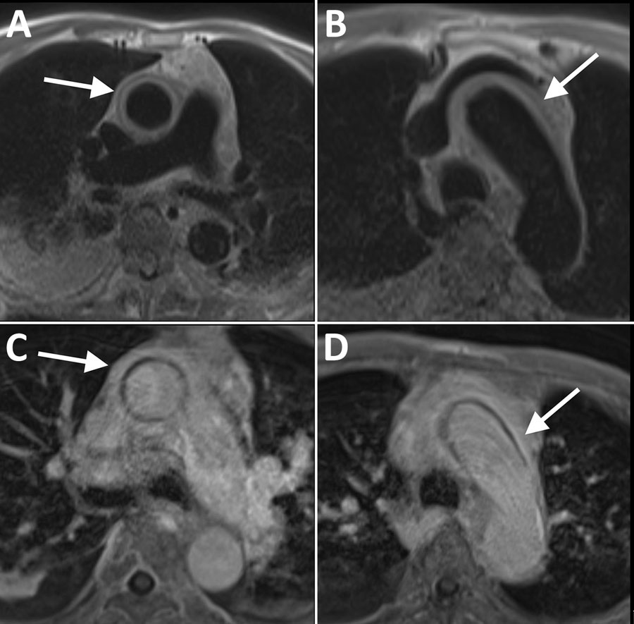 Electrocardiogram-gated magnetic resonance imaging of the ascending aorta in an 89-year-old patient with syphilitic aortitis and concomitant neurosyphilis, Washington, DC, USA. A, B) A circumferential periaortic T2 hyperintense signal was depicted at the main pulmonary artery (A) and aortic arch (B) on black blood prepared half-Fourier acquisition single-shot turbo spin-echo sequence images (white arrows). C, D) Contrast-enhanced T1-weighted magnetic resonance images at the main pulmonary artery (C) and aortic arch (D) show wall thickening and enhancement (white arrows) compatible with aortitis.