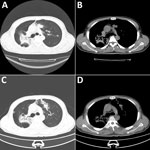 Chest computed tomography (CT) images from a patient with disseminated blastomycosis mimicking tuberculosis, China. A, B) Chest CT at first admission revealed bilateral lobar infiltrates (A) and patchy opacities (B). C, D) Chest CT taken 2 months later showed resolution of left lung lesions but progression of right lung lesions.
