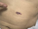 Cutaneous lesion on the abdomen from a case of disseminated blastomycosis mimicking tuberculosis, China. Two months after treatment for tuberculosis, new cutaneous lesions developed on the patient’s abdomen and lower limbs; molecular methods on bronchoalveolar lavage fluid detected Blastomyces percursus.