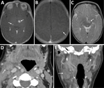 Imaging from infant and mother in case of congenital tularemia with neuroinvasive disease, Utah, USA. A, B) Axial T1 post-contrast images showing the infant’s initial magnetic resonance imaging findings of rim enhancing lesions near the left subthalamic nucleus and right inferior thalamus (arrows, panel A), as well as a punctate enhancing lesion in the left parietal lobe (arrow, panel B). C) Axial T2 image demonstrating T2 hyperintense edema along the margins of the largest lesion near the left subthalamic nucleus (arrow). D, E) Axial (D) and coronal (E) images from the mother’s computed tomography scan with intravenous contrast showing an enlarged, heterogeneous right cervical chain lymph node with inflammatory stranding in the adjacent soft tissues (arrows).
