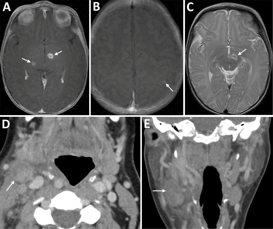 Imaging from infant and mother in case of congenital tularemia with neuroinvasive disease, Utah, USA. A, B) Axial T1 post-contrast images showing the infant’s initial magnetic resonance imaging findings of rim enhancing lesions near the left subthalamic nucleus and right inferior thalamus (arrows, panel A), as well as a punctate enhancing lesion in the left parietal lobe (arrow, panel B). C) Axial T2 image demonstrating T2 hyperintense edema along the margins of the largest lesion near the left subthalamic nucleus (arrow). D, E) Axial (D) and coronal (E) images from the mother’s computed tomography scan with intravenous contrast showing an enlarged, heterogeneous right cervical chain lymph node with inflammatory stranding in the adjacent soft tissues (arrows).