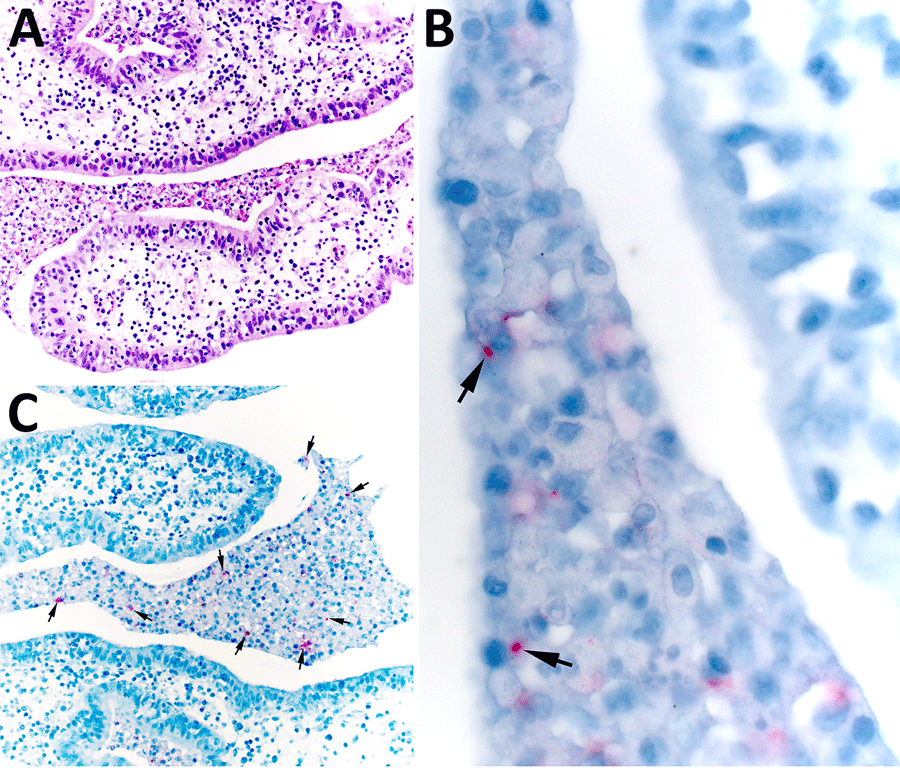 Histopathology in study of congenital tularemia with neuroinvasive disease, Utah, USA. Histopathological evaluation revealed the presence of subacute suppurative salpingitis with serositis. A) Hematoxylin and eosin–stained tissue showing abundant necroinflammatory debris in the lumen of the left fallopian tube. The endosalpinx was edematous, and infiltrating neutrophils and mononuclear cells were seen in the lamina propria and tubal epithelium. Original magnification ×200. B) Higher-power microphotograph highlights immunostaining within intracellular coccobacilli (arrows). Original magnification ×630. C) Francisella tularensis immunohistochemistry showing immunoreactive granular forms of bacterial antigens (arrows) within areas of the luminal necroinflammatory infiltrate. Original magnification ×200.