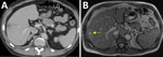 Imaging findings from a study of syphilis as a rare cause of pyogenic liver abscess in an HIV-positive man in Minnesota, USA. Computed tomography (A) and magnetic resonance imaging (B) of the abdomen and pelvis show rim-enhancing lesion (yellow arrows) in segments 5 and 6 of the liver.