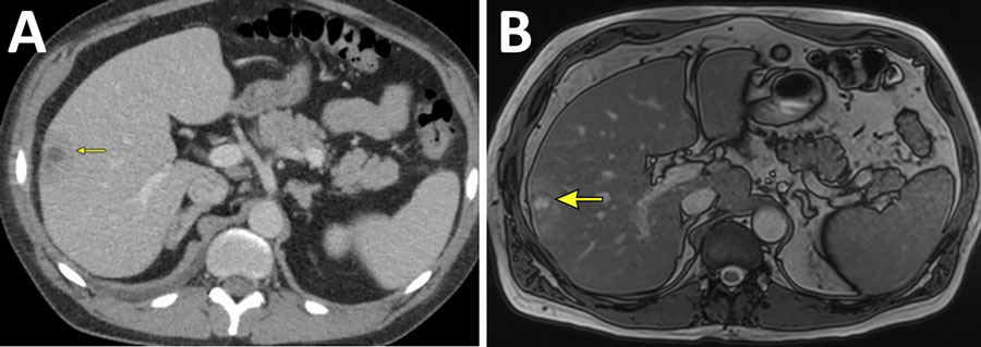 Imaging findings from a study of syphilis as a rare cause of pyogenic liver abscess in an HIV-positive man in Minnesota, USA. Computed tomography (A) and magnetic resonance imaging (B) of the abdomen and pelvis show rim-enhancing lesion (yellow arrows) in segments 5 and 6 of the liver.