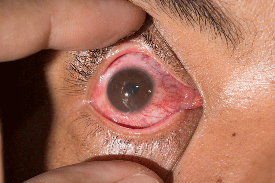 Anterior uveitis in a patient from a series of cases of ocular Lyme disease. Uveitis may be distinguished from the more common conjunctivitis (pink eye) by any number of features that warrant an ophthalmology examination. Uveitis is more likely to have eye pain, light sensitivity, smaller or irregular-shaped pupil, blurry vision, and floaters.