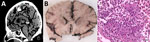 Radiologic and pathologic findings from a fatal pneumocephalus case caused by hypervirulent Klebsiella pneumoniae in Germany. A) Computed tomography imaging of the neurocranium revealing gas inclusions both in the arterial and venous system and the inner and outer cerebrospinal fluid spaces consistent with an intravital pneumocephalus. B) Postmortem coronal brain section revealing infiltrates of the leptomeninges and signs of global hypoxic-ischemic brain damage including blurred demarcation between the white and gray matter and discoloration. C) Microscopic appearance of purulent meningitis with bacilli accumulating in the leptomeninges. Hematoxylin and eosin stain. Scale bar indicates 50 µm.