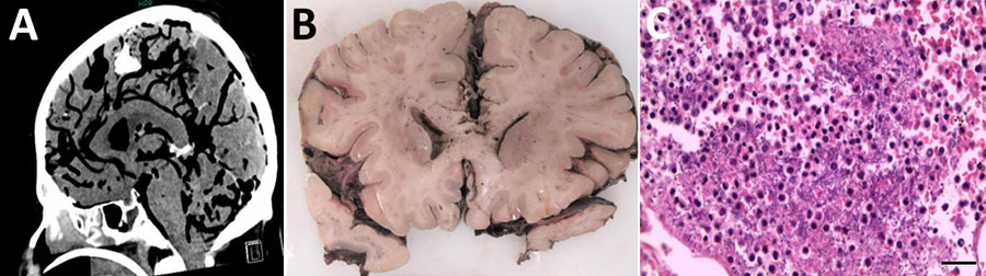 Radiologic and pathologic findings from a fatal pneumocephalus case caused by hypervirulent Klebsiella pneumoniae in Germany. A) Computed tomography imaging of the neurocranium revealing gas inclusions both in the arterial and venous system and the inner and outer cerebrospinal fluid spaces consistent with an intravital pneumocephalus. B) Postmortem coronal brain section revealing infiltrates of the leptomeninges and signs of global hypoxic-ischemic brain damage including blurred demarcation between the white and gray matter and discoloration. C) Microscopic appearance of purulent meningitis with bacilli accumulating in the leptomeninges. Hematoxylin and eosin stain. Scale bar indicates 50 µm.