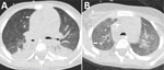 Chest computed tomography scan of a 4-year-old male patient with acute myeloid leukemia in study of Bjerkandera spp. pulmonary infection in immunocompromised hosts, Germany. The patient experienced fever unresponsive to antimicrobial treatment. A) Imaging revealed nodular infiltrates and surrounding ground-glass opacities in both lungs (arrow). Bjerkandera spp. was identified from tracheal aspiration. B) Follow-up computed tomography scan after 4 weeks demonstrated regressive nodular lesions and the formation of a cavity in the right upper lobe (arrow).