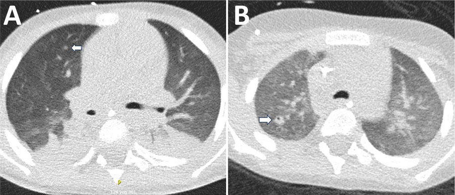 Chest computed tomography scan of a 4-year-old male patient with acute myeloid leukemia in study of Bjerkandera spp. pulmonary infection in immunocompromised hosts, Germany. The patient experienced fever unresponsive to antimicrobial treatment. A) Imaging revealed nodular infiltrates and surrounding ground-glass opacities in both lungs (arrow). Bjerkandera spp. was identified from tracheal aspiration. B) Follow-up computed tomography scan after 4 weeks demonstrated regressive nodular lesions and the formation of a cavity in the right upper lobe (arrow).