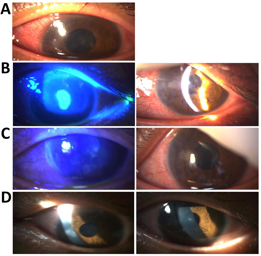 Ophthalmologic evaluation of patient with severe ocular mpox treated with cidofovir and tecovirimat. Images are of patient’s left eye over course of diagnosis and treatment. A) Slit-lamp examination at day 0, showing corneal edema, a pseudodendritic ulcer, and conjunctival hyperemia characteristic of disciform kerititis. B) On day 5, before first-line treatment with valaciclovir, fluorescein (left) showing and slit-lamp examination (right) showing persistent keratitis and formation of new corneal infiltrates. C) On day 21, seven days after initiation of second-line antiviral drug treatment with cidofovir and tecovirimat, fluorescein (left) and slit-lamp examination (right) showing marked clinical improvement and reduction in infiltrates. D) On day 29, fourteen days after treatment with second-line antiviral drug treatment with cidofovir and tecovirimat, left and right images are of slit-lamp examination showing complete resolution of corneal edema, conjunctival hyperemia, and inflammatory signs.