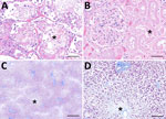 Microscopic findings from autopsy of liver transplant recipient with fatal Ehrlichia muris eauclairensis infection, Minnesota, USA. A) Hematoxylin and eosin stain of lung tissue shows acute diffuse alveolar damage with intraalveolar edema (asterisk) and focal hyaline membranes. Scale bar indicates 100 μm. B) Hematoxylin and eosin stain of kidney tissue shows acute tubular injury (asterisk). Scale bar indicates 50 μm. C) Masson’s trichrome stain of the liver shows prominent zone 3 necrosis (asterisk) consistent with ischemic injury. Scale bar indicates 500 μm. D) Higher magnification of panel C shows the loss of hepatocytes (asterisk) near the central vein (zone 3). Scale bar indicates 100 μm.