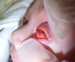Bilateral conjunctival infection, pronounced left eyelid edema, and periorbital erythema observed in a 12-day-old infant in case of neonatal gonococcal conjunctivitis caused by fluoroquinolone-resistant Neisseria gonorrhoeae, Japan, 2023.