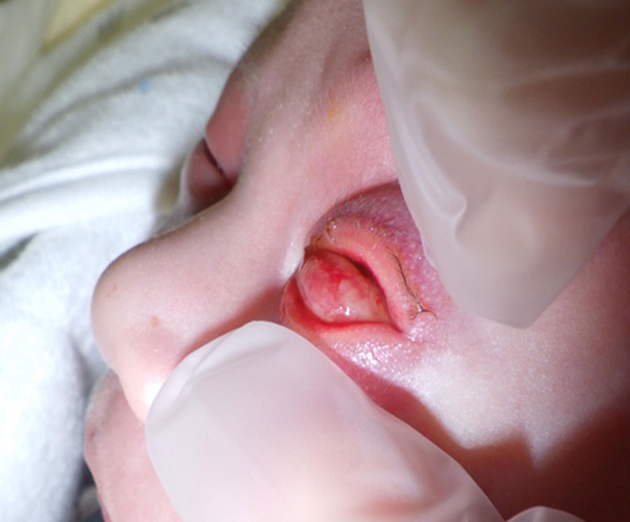 Bilateral conjunctival infection, pronounced left eyelid edema, and periorbital erythema observed in a 12-day-old infant in case of neonatal gonococcal conjunctivitis caused by fluoroquinolone-resistant Neisseria gonorrhoeae, Japan, 2023.