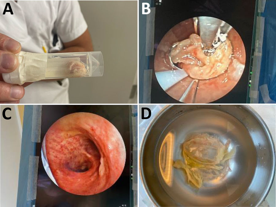 Clinical findings from a case of severe respiratory diphtheria-like illness caused by toxigenic Corynebacterium ulcerans, Norway. A) Pseudomembranes coughed up by the patient on day 1 of hospitalization. B) Pseudomembranes removed by bronchoscopy on day 4 of hospitalization. C) Trachea and carina after bronchoscopy on day 4 of hospitalization. D) Pseudomembranes removed from lower airways via bronchoscopy on day 4 of hospitalization.