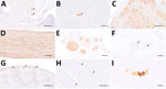 Distribution of virus antigen detected by immunohistochemistry using Bo18 antibody among peripheral organs and tissues of Borna disease virus 1–infected hedgehogs in study of the virus as cause of fatal meningoencephalomyelitis in wild hedgehogs, Germany, 2022–2025. A) Immunopositive nerve branches within the renal pelvis (arrowheads) from case 3. Scale bar represents 250 μm. B) Immunopositive ganglion neurons within salivary gland (arrow) from case 4. Scale bar represents 100 μm. C) Marked positivity within cranial mesenteric ganglion from case 3. Scale bar represents 250 μm. D) Diffusely immunopositive nerve fibers within a large fascicular nerve from case 1. Scale bar represents 100 μm. E) Large immunopositive visceral nerve branches within the mediastinum from case 2. Scale bar represents 200 μm. F) Pulmonary nerve branches with positive fibers (arrows) from case 7. Scale bar represents 100 μm. G) Widespread immunostaining of myenteric plexus (arrowheads) from case 4. Scale bar represents 250 μm. H) Immunopositive intramuscular nerve branches within the paravertebral musculature (arrowheads) from case 5. Scale bar represents 250 μm. I) A small group of immunopositive renal tubules from case 5. Scale bar represents 50 μm. All stains were 3,3′-diaminobenzidine stain with, hematoxylin counterstain.