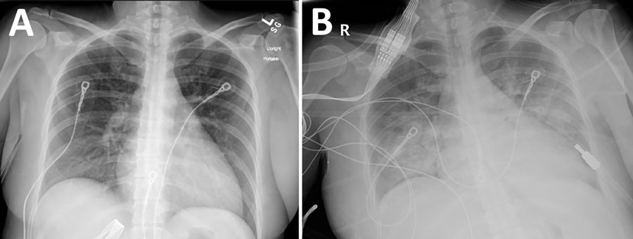 Chest radiographs from an organ donor with murine typhus, from a study describing the transmission of Rickettsia typhi from an organ donor to 2 kidney transplant recipients, Texas, 2024. A) Chest radiograph obtained at hospital admission, 5 days after symptom onset, with no specific abnormalities noted. B) Chest radiograph obtained on hospital day 3, revealing extensive alveolar opacities predominantly in the middle and lower lung fields.