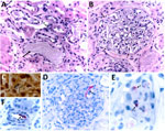 Histopathological and immunohistochemical features of formalin-fixed, paraffin-embedded biopsy specimens collected from the right and left kidney allografts procured from a donor who died of murine typhus, from a study describing the transmission of Rickettsia typhi from an organ donor to 2 kidney transplant recipients, Texas, 2024. A) When stained with hematoxylin and eosin, both allografts showed multifocal, interstitial, and predominantly mononuclear peritubular infiltrates, associated with focal endarteritis (thin arrows), features of acute tubular injury, including epithelial attenuation with loss of apical cytoplasm, and pigmented casts (large arrow). B) Glomeruli displayed moderate mesangial hypercellularity and tuft adhesions to the Bowman’s capsules (arrows) and intracapillary and mesangial phagocytic foam-cells. C) Short chains comprising small, rod-shaped bacteria were revealed in glomerular capillaries by the Warthin–Starry silver impregnation staining technique. D–F) An immunohistochemical stain for typhus-group rickettsiae revealed intact bacteria within endothelial cells of inflamed small vessels and vascular spaces of mesangial capillaries (arrows) and phagocytized bacterial antigens in the cytoplasm of glomerular foam-cells (arrows). Original magnifications ×400 (A, B, and E) and ×1,000 (C, D, and F).