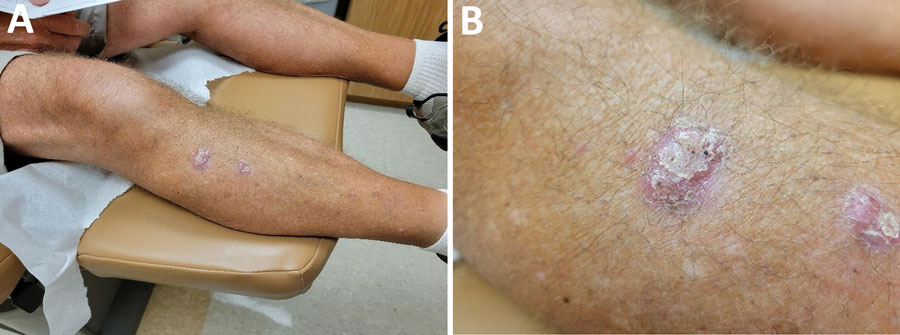 Scaly and crusted pink verrucous nodules clustered on right shin of lung transplant recipient with cutaneous Paraconiothyrium cyclothyrioides infection, Georgia, USA.