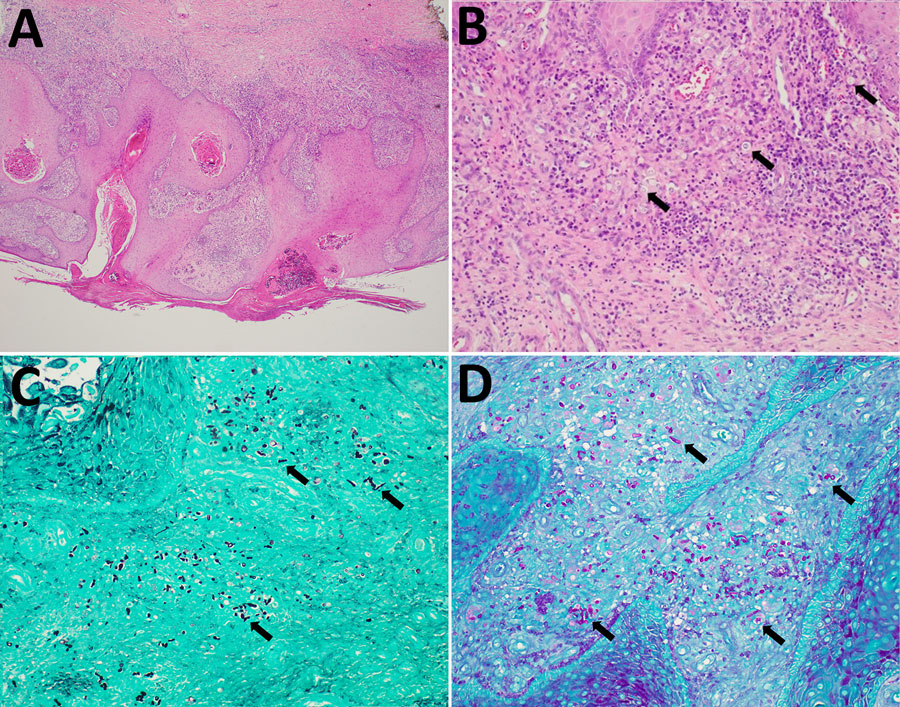 Histologic (A, B) and histochemical (C, D) findings from case of cutaneous Paraconiothyrium cyclothyrioides in lung transplant recipient, Georgia, USA. A) Skin biopsy from right shin revealed psuedoepitheliomatous hyperplasia of the epidermis overlying a mixed dermal inflammatory infiltrate. Hematoxylin and eosin stain; original magnification ×40. B) Polymorphic fungal elements (arrows) seen within the superficial dermis. Hematoxylin and eosin stain; original magnification ×200. C) Numerous fungal hyphal elements and yeast-like forms (arrows) highlighted within the dermis. Grocott methenamine silver stain; original magnification ×200. D) Fungal hyphal elements and yeast-like forms (arrows) noted by Periodic acid–Schiff stain; original magnification ×200.