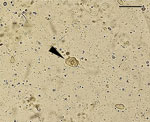 Microscopic view of Entamoeba moshkovskii trophozoites (arrowhead) observed in a pleural fluid sample recovered from a patient with an extraintestinal infection, eastern India. Slide used a wet-mount preparation,. Scale bar indicates 30 μm.