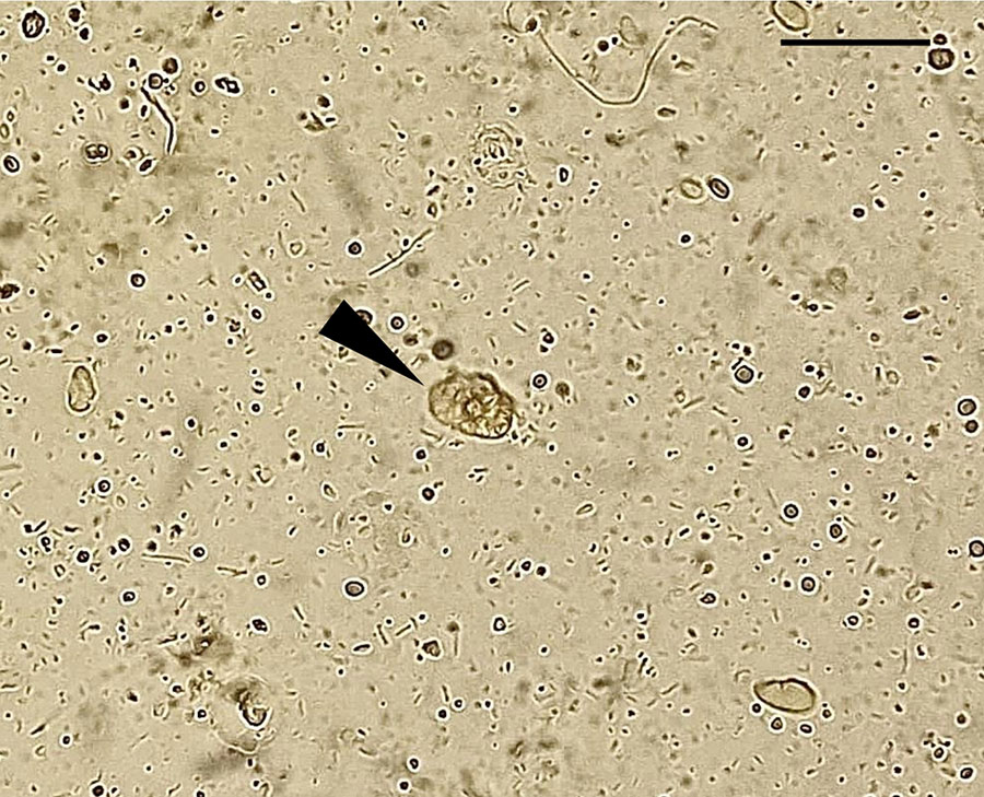 Microscopic view of Entamoeba moshkovskii trophozoites (arrowhead) observed in a pleural fluid sample recovered from a patient with an extraintestinal infection, eastern India. Slide used a wet-mount preparation,. Scale bar indicates 30 μm.