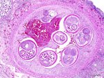 Lung tissue from a roof rat (Rattus rattus) with autochthonous rat lungworm Angiostrongylus cantonensis infection, San Diego, California, USA, 2025. Hematoxylin and eosin stain of pulmonary arteries with intravascular adult metastrongyle nematodes have severe endothelial proliferation. The surrounding lung parenchyma is replaced by granulomatous inflammation centered on numerous larvated and morulated eggs. Scale bar indicates 250 µm.