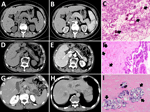 Imaging from 4 cases of pancreatic schistosomiasis, China, 2020–2024. A, B) Computed tomography (CT) images from patient 1 revealing a mass involving the pancreas. C) Pathologic examination from fine-needle aspiration of patient 1 showing fibrinous exudate and schistosome eggs (arrows). D, E) Abdominal CT of patient 2 showing a nonenhancing, tubular lesion adjacent to the main pancreatic duct in the body of the pancreas. F) Pathologic examination of sample from patient 2 showing intraductal papillary mucinous neoplasm with moderate dysplasia and scattered schistosome eggs (arrows). G, H) Abdominal CT of patient 3 revealing a low-density mass in the pancreatic tail and multiple ring-enhancing hepatic nodules. I) Pathologic examination of sample from patient 3 showing schistosome egg deposition (arrows) with associated tissue necrosis. 