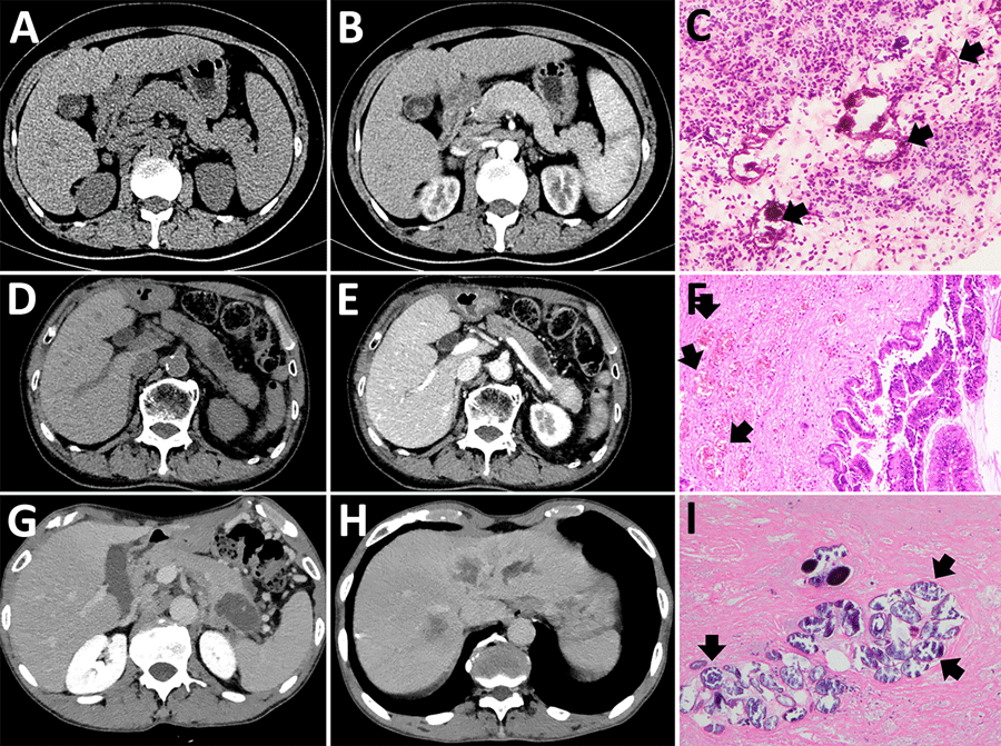 Imaging from 4 cases of pancreatic schistosomiasis, China, 2020–2024. A, B) Computed tomography (CT) images from patient 1 revealing a mass involving the pancreas. C) Pathologic examination from fine-needle aspiration of patient 1 showing fibrinous exudate and schistosome eggs (arrows). D, E) Abdominal CT of patient 2 showing a nonenhancing, tubular lesion adjacent to the main pancreatic duct in the body of the pancreas. F) Pathologic examination of sample from patient 2 showing intraductal papillary mucinous neoplasm with moderate dysplasia and scattered schistosome eggs (arrows). G, H) Abdominal CT of patient 3 revealing a low-density mass in the pancreatic tail and multiple ring-enhancing hepatic nodules. I) Pathologic examination of sample from patient 3 showing schistosome egg deposition (arrows) with associated tissue necrosis.