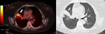 Computed tomography scans of a healthcare workers with occupationally transmitted extensively drug-resistant tuberculosis, France. Scan revealed hypermetabolism (standardized update value 9.1) of the right upper lobe alveolar consolidation, indicated by white arrows.