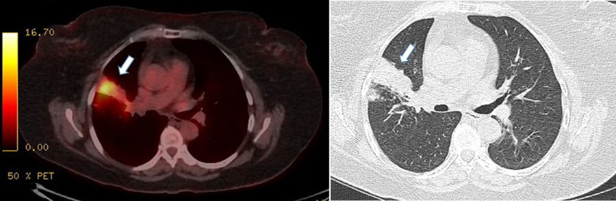 Computed tomography scans of a healthcare workers with occupationally transmitted extensively drug-resistant tuberculosis, France. Scan revealed hypermetabolism (standardized update value 9.1) of the right upper lobe alveolar consolidation, indicated by white arrows.