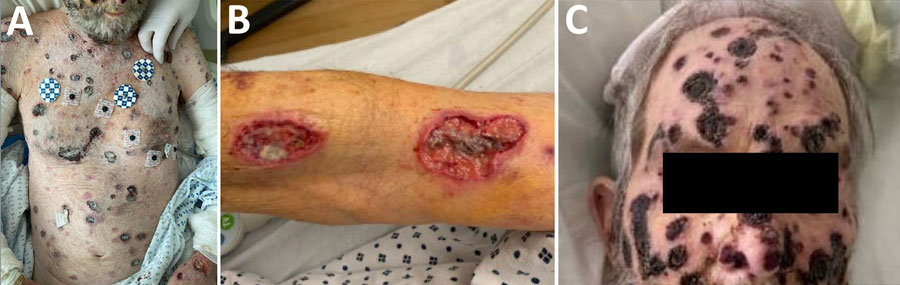 Images of skin lesions on a patient with disseminated Acanthamoeba infection with necrotic skin lesions and granulomatous vasculitis. A) Lesions on the patient’s body. B) Deeply ulcerated lesions on the patient. C) Lesions that extended to the head and face.