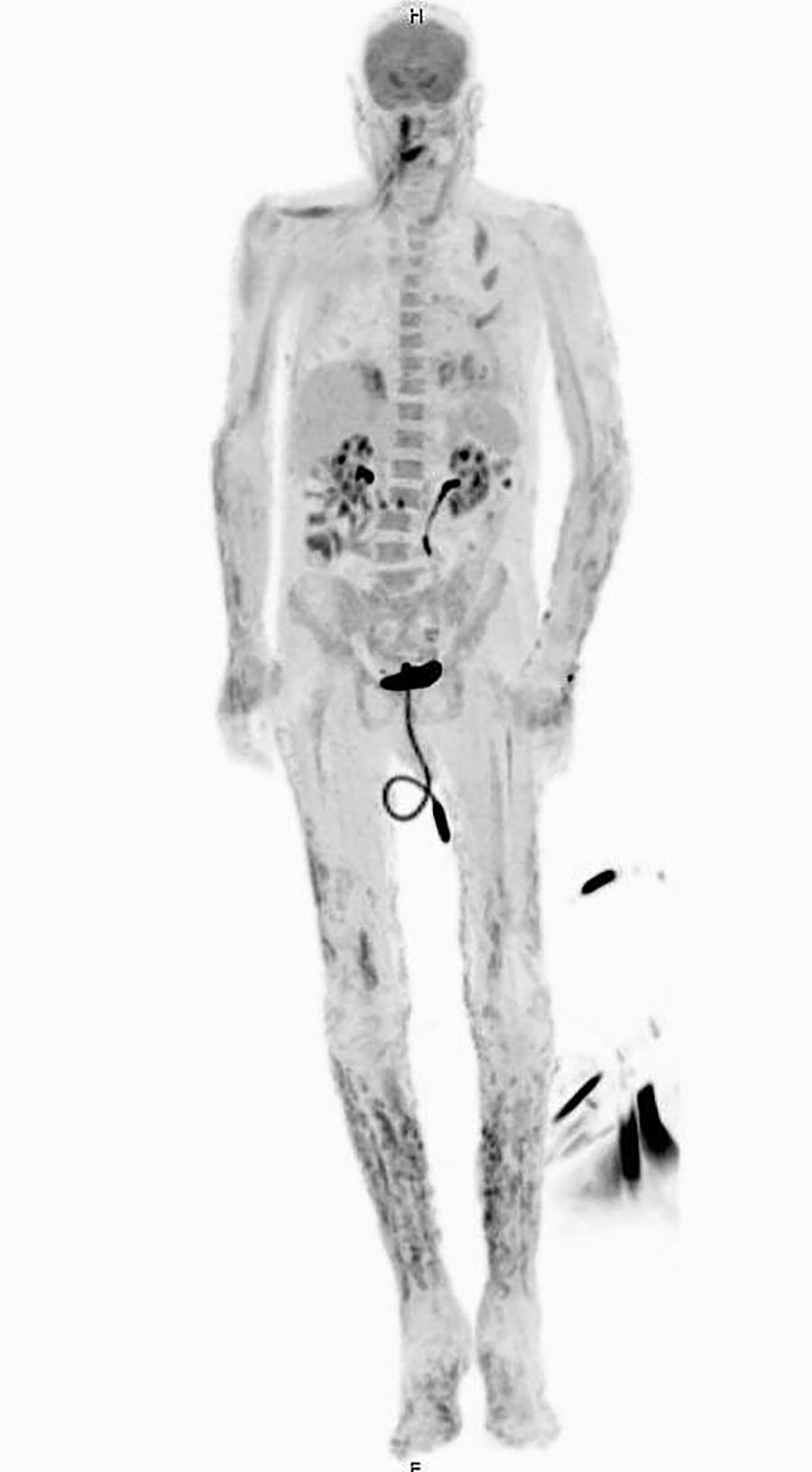 Positron emission tomography/computed tomography showing innumerable widespread 18F-fluorodeoxyglucose avid cutaneous and subcutaneous lesions that developed in a patient with disseminated Acanthamoeba infection.